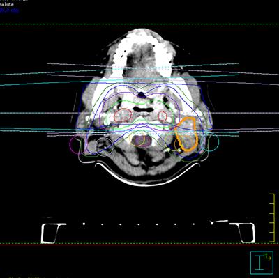 Case Report: Chemotherapy and Radiotherapy Combined With DC-CIK for Pulmonary and Mediastinal Metastases From Nasopharyngeal Carcinoma